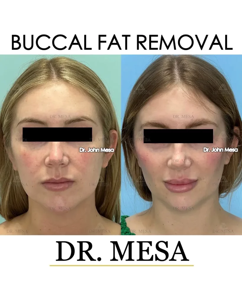A female patient's before and after photo, after getting Buccal Fat Removal by Dr. Mesa.