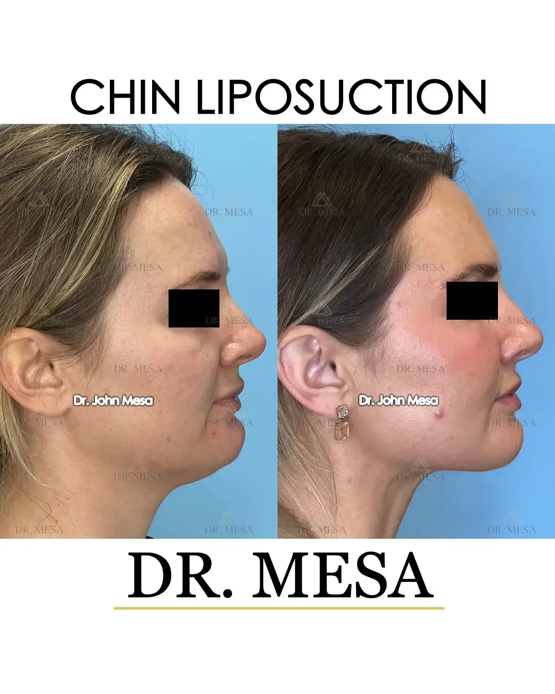 Chin Liposuction for Women: Before & After by Dr. Mesa