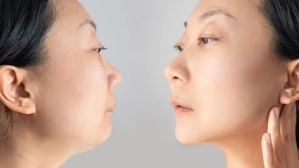 Female patient thinking about Chin Liposuction tips and insights