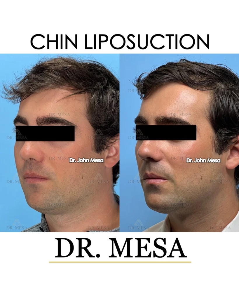 Chin Liposuction male before and after photos in NYC
