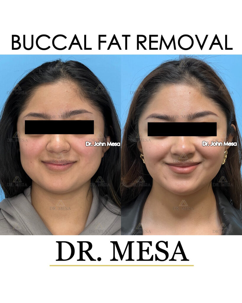 buccal fat removal before and after female patient results