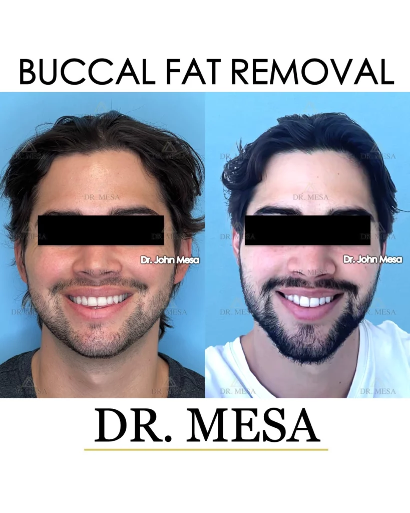 A male patient's dramatic before and after photos, after Buccal Fat Removal