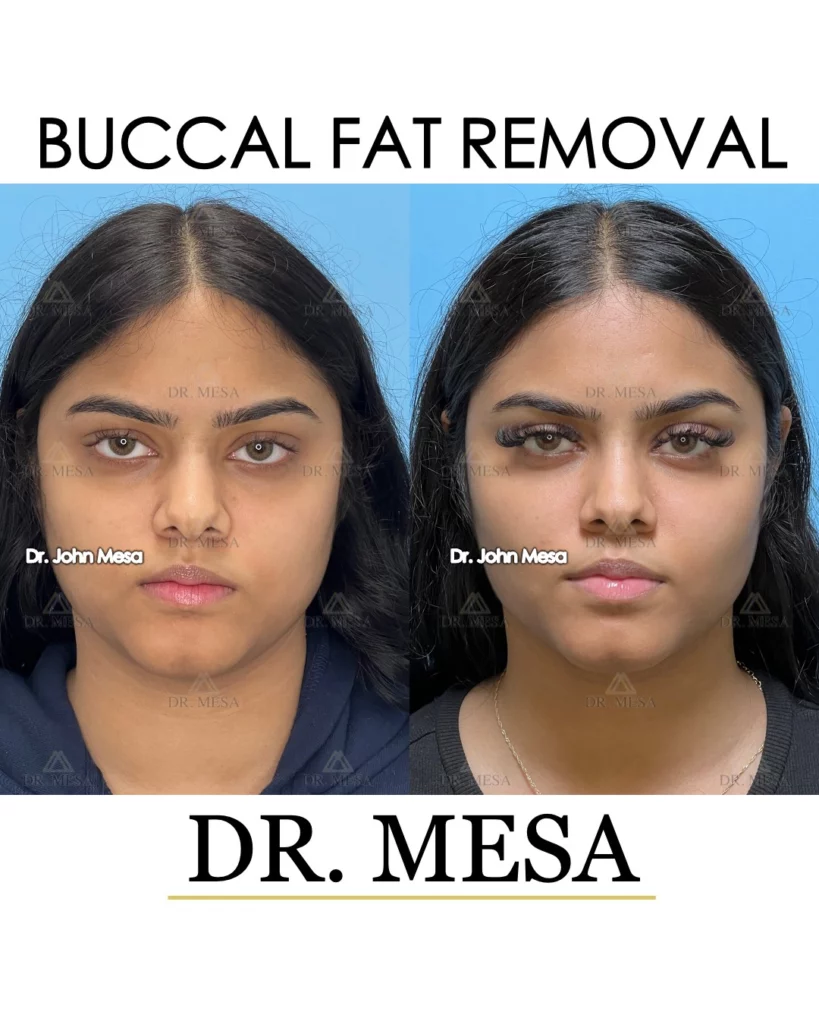 Before and after buccal fat removal in Miami