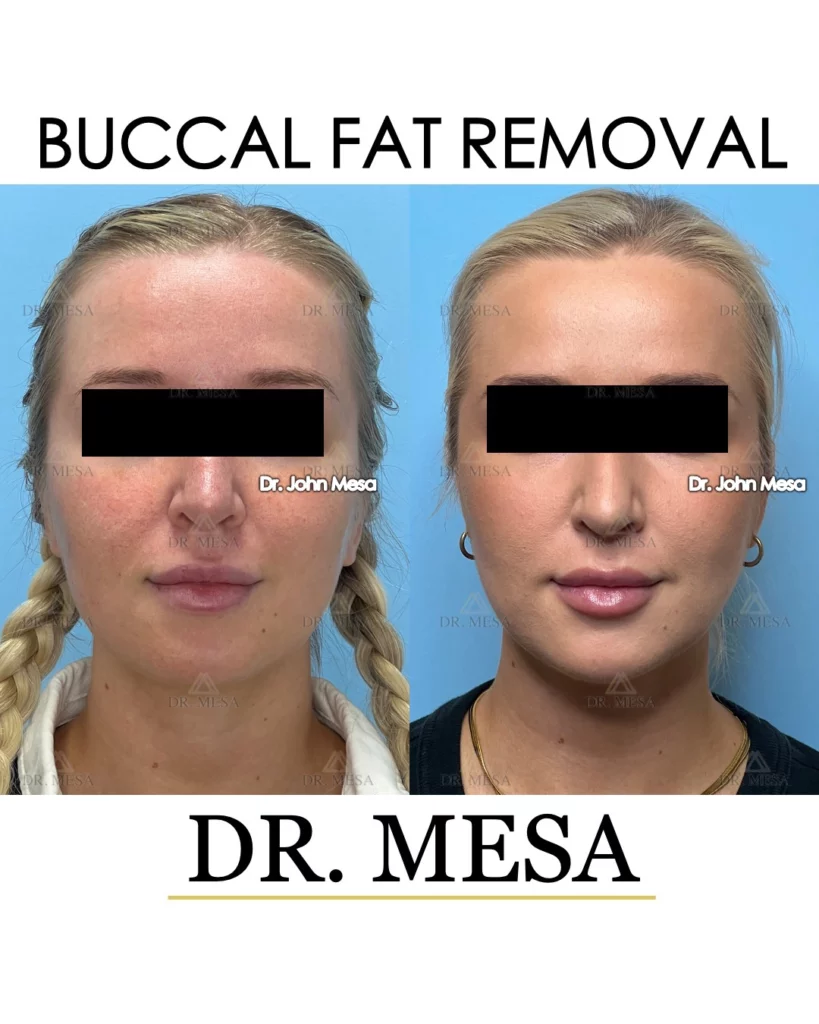 Before and after buccal fat removal for women