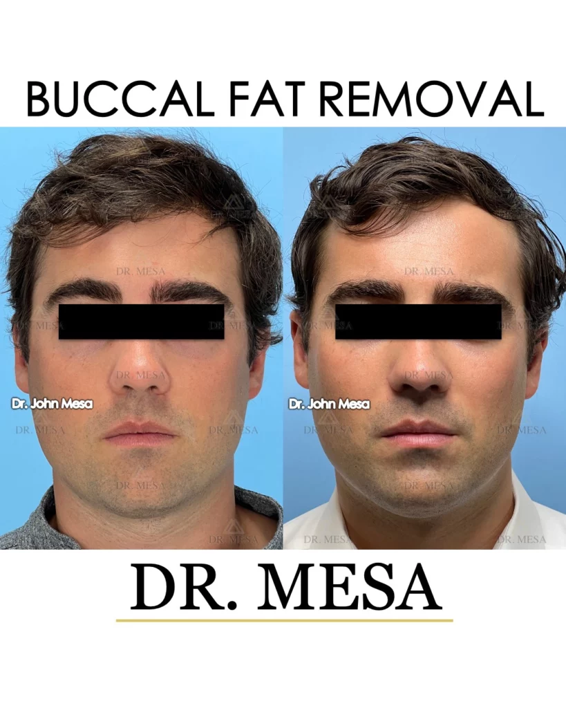 Before and after Buccal fat removal for men in New Jersey