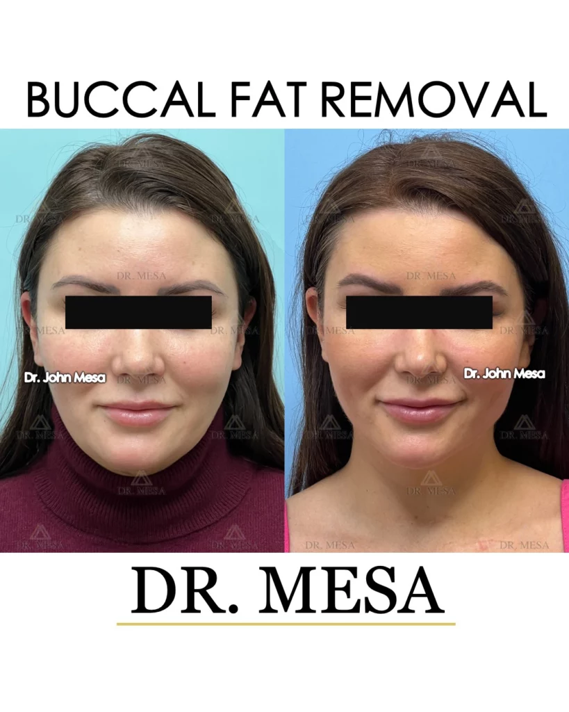 Before and after buccal fat removal in NYC