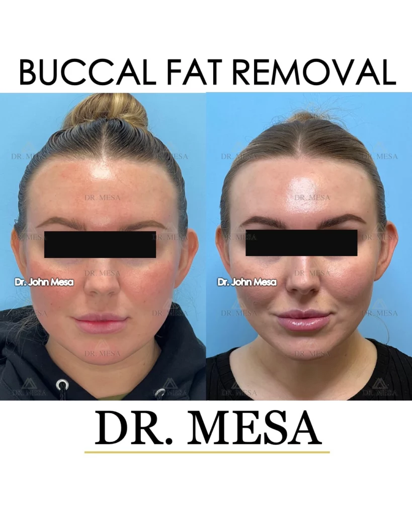 Before and after buccal fat removal in New Jersey