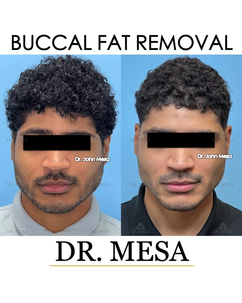 Before and after Buccal fat removal for men in Miami