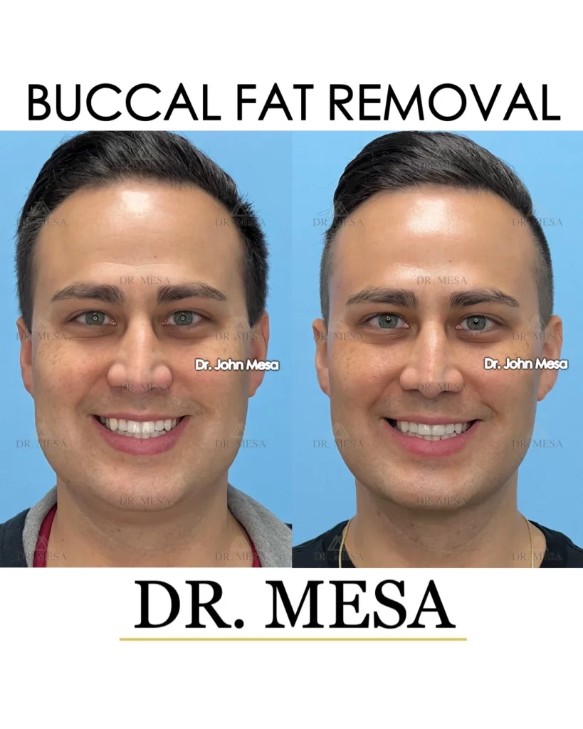 Buccal fat removal for men before and after