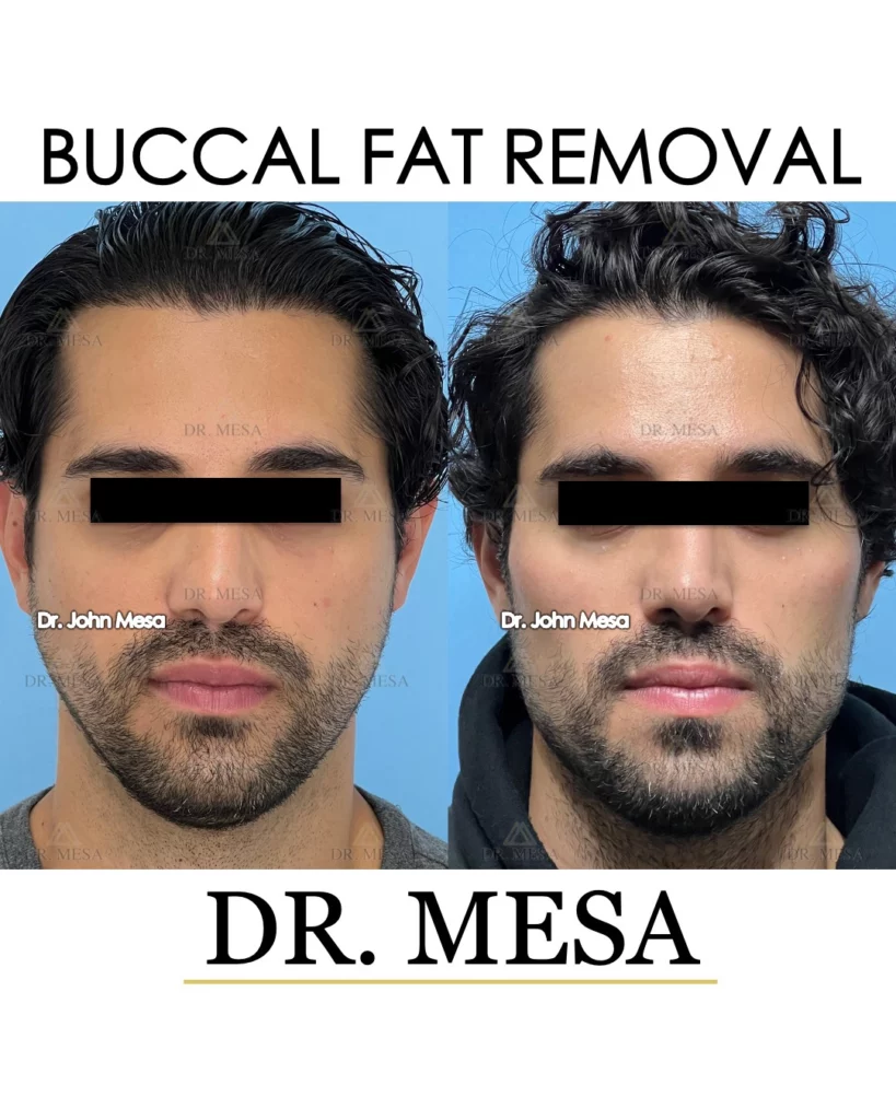 Before and after Buccal fat removal for men in New York City