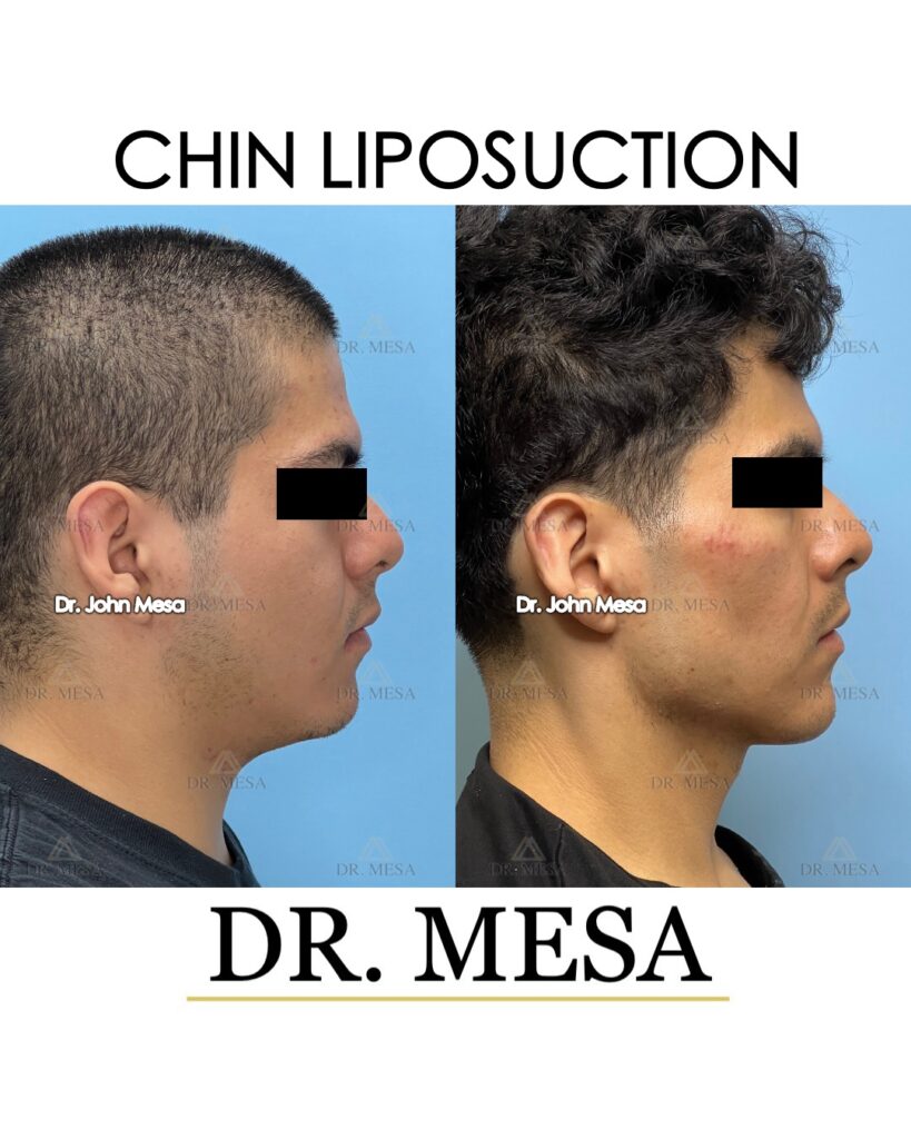 Chin-Liposuction-18yoM- 004