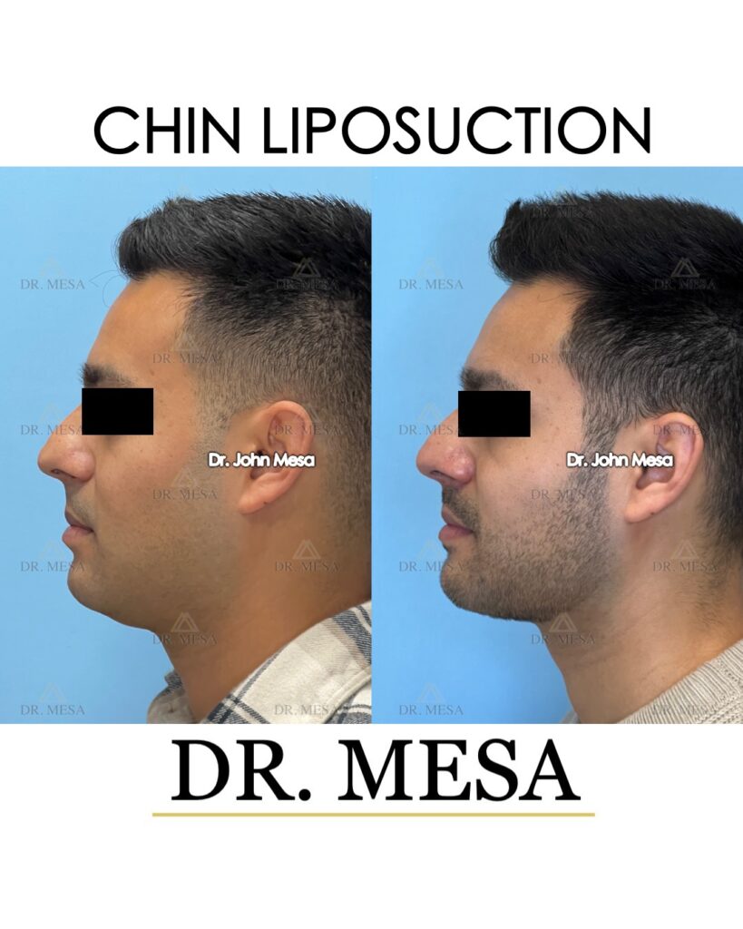 Chin-Liposuction-31yoM- 006