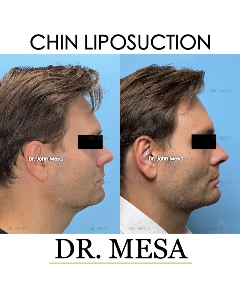 Chin-Liposuction-33yoM- 004