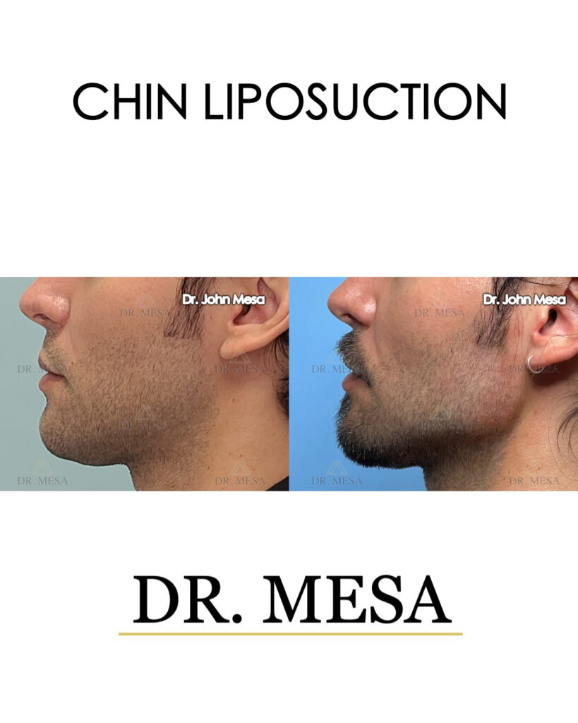 Chin-Liposuction-34yoM- 005