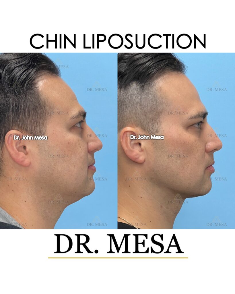 Chin-Liposuction-37yoM- 003