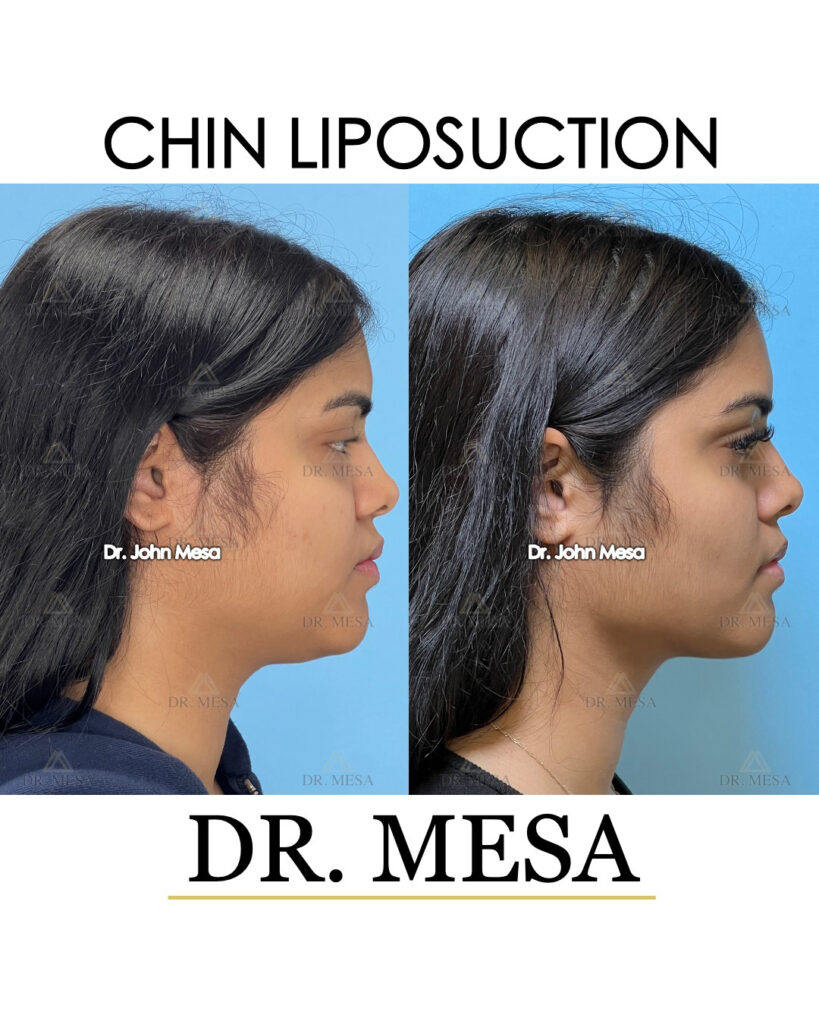 ChinLipo-20yoF-010