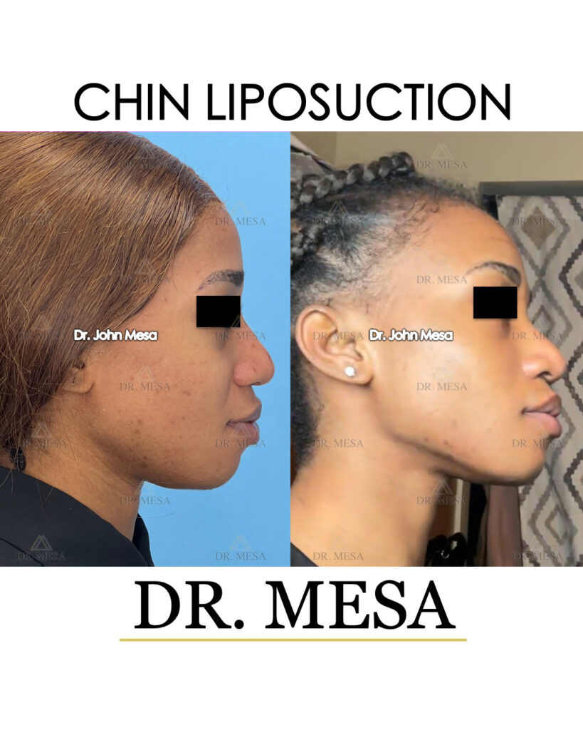 ChinLipo-21yoF-008 (1)