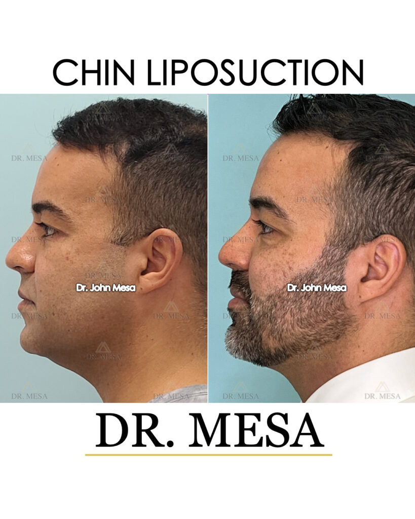 ChinLipo-36yoM-010