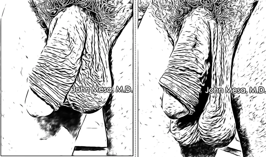 Privacy-filtered Scrotox before-and-after comparison showing differences in scrotal skin texture after treatment by John Mesa, MD.